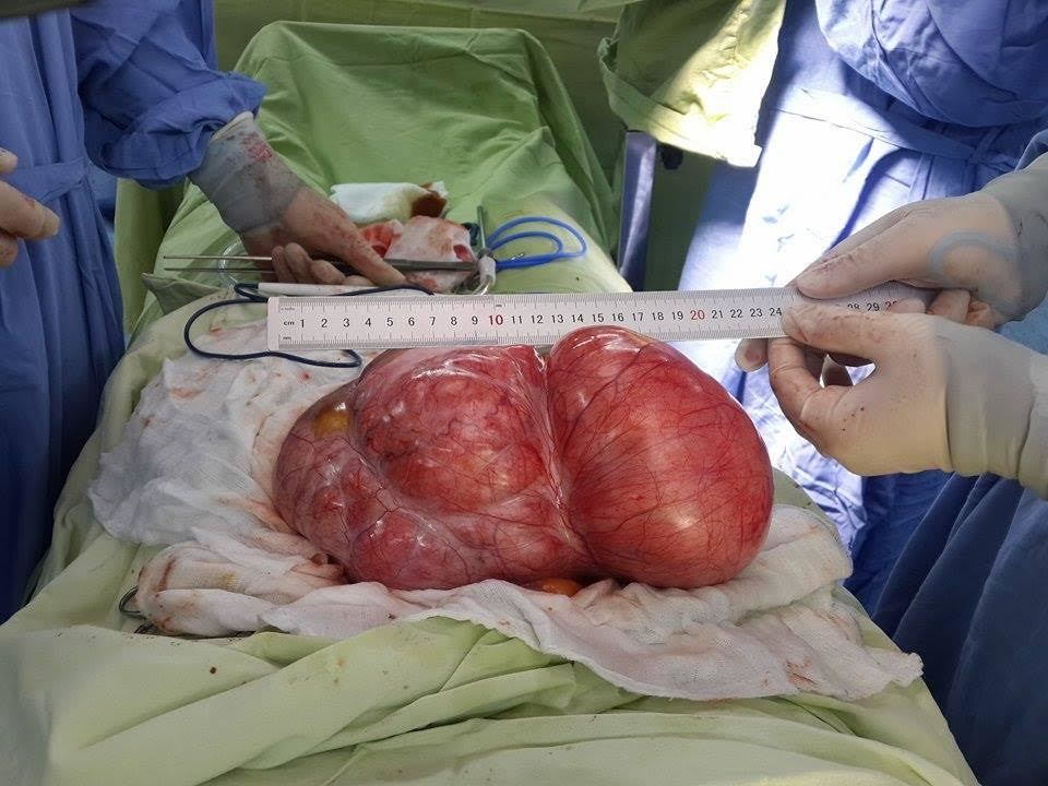Cắt khối u hơn 4kg, cứu sống bệnh nhân ung thư