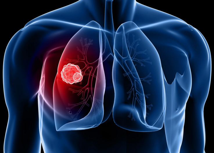 Cách phát hiện các triệu chứng của ung thư phổi