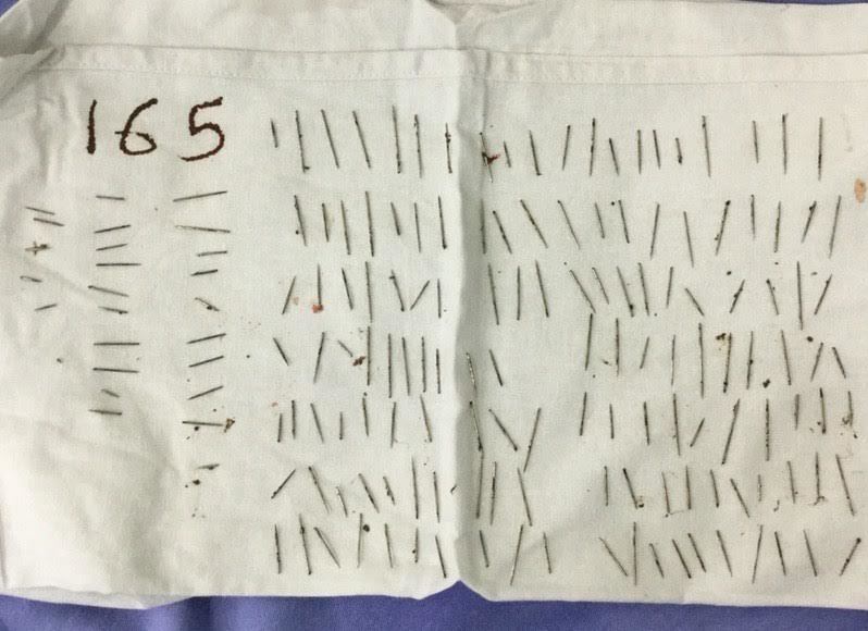 Cô gái tự đâm 165 cây kim xuyên vào vai