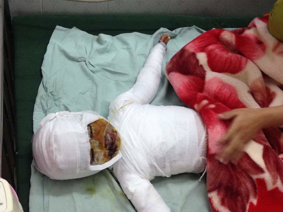 Bố mẹ khuyết tật, ăn còn chưa đủ tiền đâu chữa bỏng cho con?