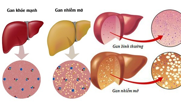 Gan nhiễm mỡ - Bệnh thời hiện đại