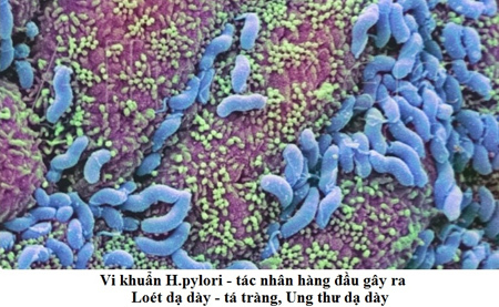 Diệt vi khuẩn H. pylori, phòng sớm bệnh dạ dày