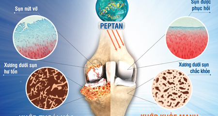 Giải pháp mới cho người thoái hóa khớp