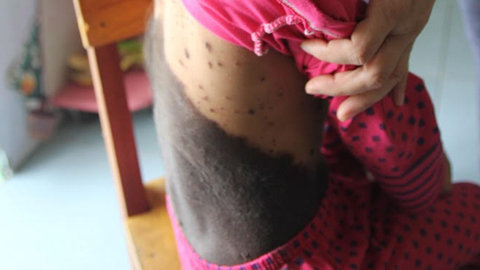 Bé gái 5 tuổi mọc lông khắp người