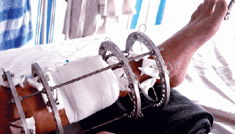 Muốn kéo dài chân để thi người mẫu