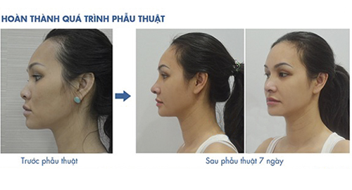 Nâng mũi S line có để lại biến chứng?