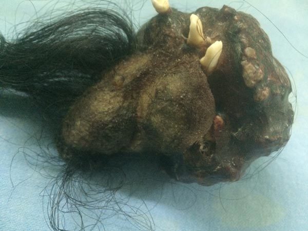 benh la, di thuong, thai trong thai, dot bien, An Do, bệnh lạ, dị thường, đột biến, Ấn Độ, đau bụng