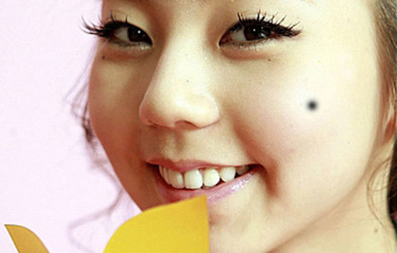 Nốt ruồi chảy máu, coi chừng ung thư