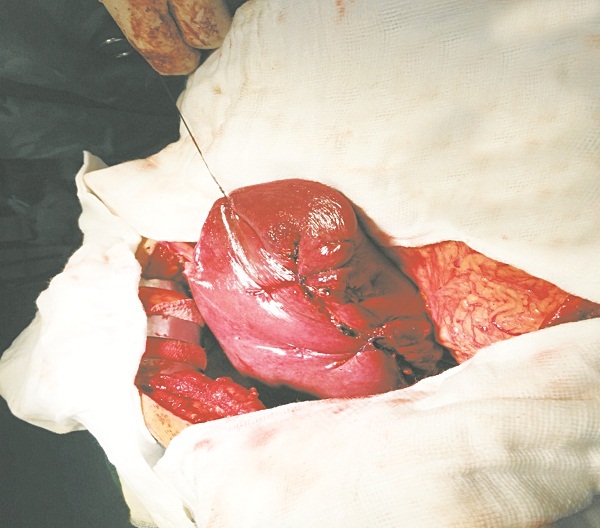 Ung thư gan: Cách phát hiện và phòng bệnh