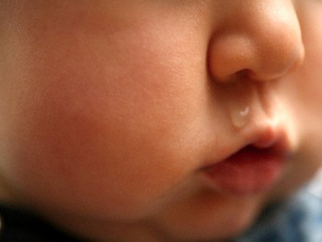 Rét đậm gây viêm phổi, trẻ có thể hôn mê