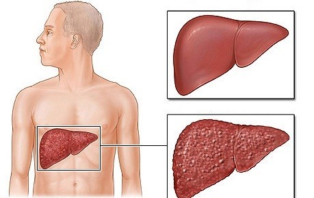 Các thuốc gây độc cho gan