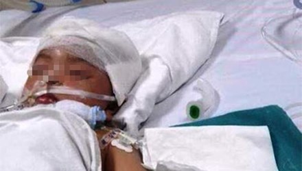 Bé 3 tuổi bị vợt cầu lông đâm xuyên não