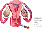 Tiêm tinh trùng vào tử cung, tỉ lệ đậu thai bao nhiêu?