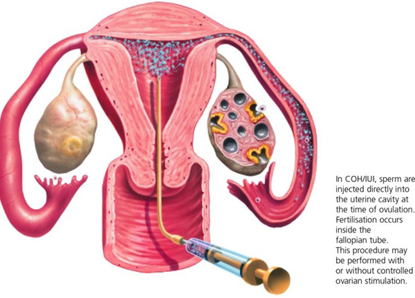 Tiêm tinh trùng vào tử cung, tỉ lệ đậu thai bao nhiêu?