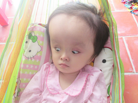 Xót thương bé gái 4 tuổi bị não úng thủy