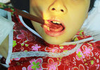 Bé gái bị đôi đũa xuyên thủng lưỡi trong lúc ăn cơm
