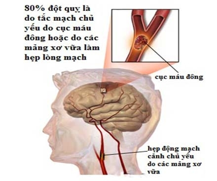 8 món ăn cho người tai biến mạch máu não