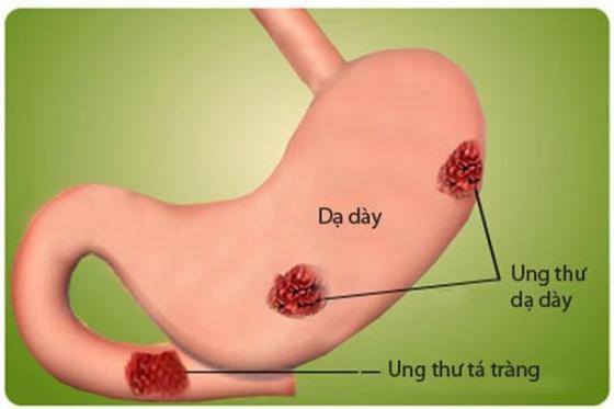 Ung thư dạ dày: 'Sát thủ' lặng lẽ