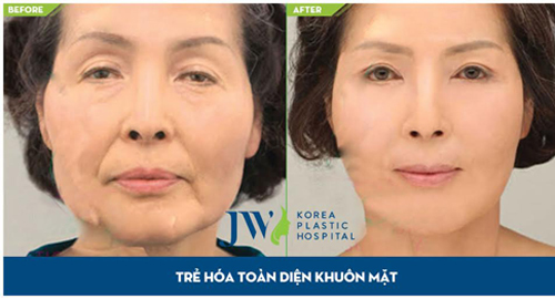 Cấy mỡ trẻ hóa khuôn mặt cùng chuyên gia Hàn Quốc