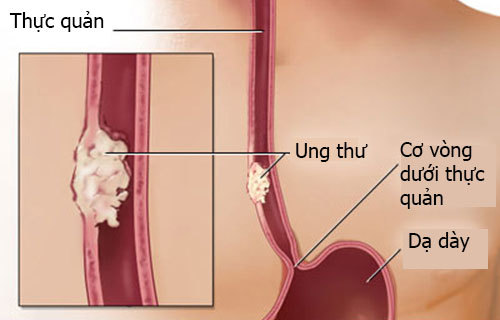 Dấu hiệu dễ thấy của ung thư thực quản