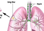 Ho kéo dài, đau ngực nghĩ ngay đến ung thư phổi