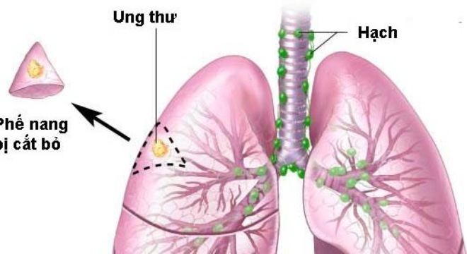 Ho kéo dài, đau ngực nghĩ ngay đến ung thư phổi