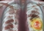 Ung thư phổi xâm nhập, tàn phá cơ thể như thế nào?