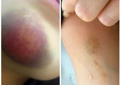 Cô gái tố bị phụ xe sàm sỡ, đánh bầm dập trên xe buýt