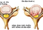 2 cách đơn giản phòng thoát vị đĩa đệm