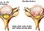 2 cách đơn giản phòng thoát vị đĩa đệm