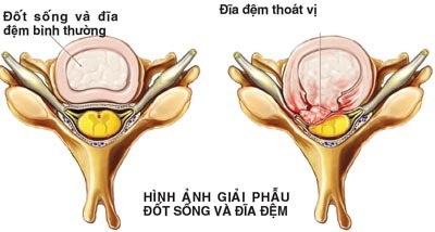 2 cách đơn giản phòng thoát vị đĩa đệm