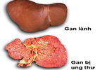 Giảm 1-2 kg/tháng, hãy nghĩ ngay đến ung thư gan