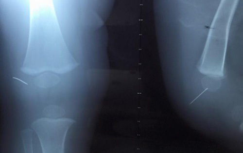 Kim khâu 'chạy' trong gối bé trai 1 tuổi