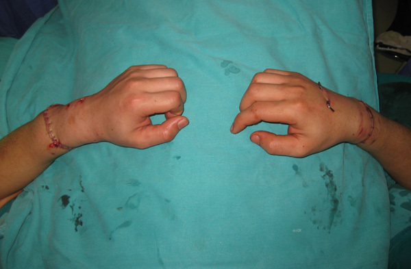 Xuyên đêm nối 2 cánh tay đứt lìa cho nam thanh niên