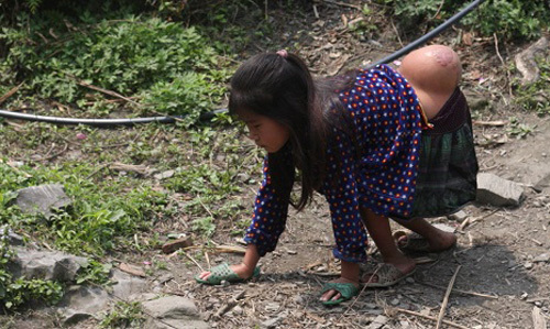 Hết đi 4 chân, bé gái cõng khối u mỉm cười ra viện