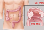 Phát hiện sớm ung thư đại trực tràng