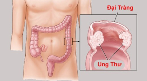 Phát hiện sớm ung thư đại trực tràng
