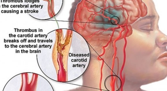 Dấu hiệu bạn sắp đột quỵ mà không biết