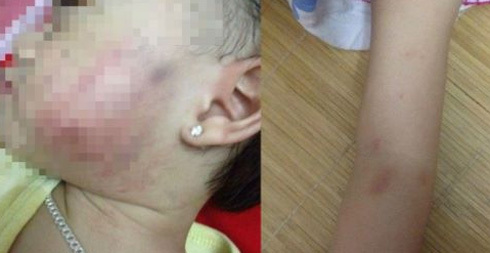Phụ huynh phản ánh bé 17 tháng bị cô giáo tát tím má