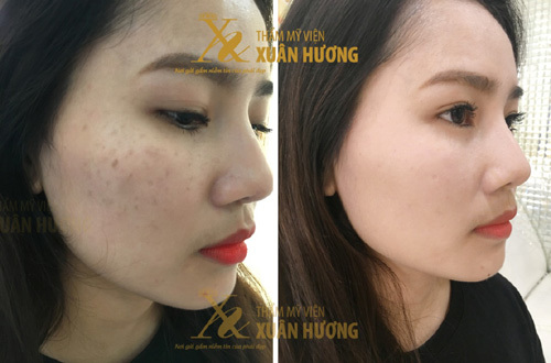 Cô gái Hà Nội 5 năm gian nan trị nám