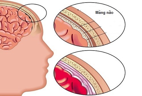 Viêm màng não: Dấu hiệu ít ai ngờ