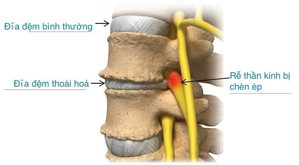 Thoái hóa đĩa đệm: Mổ có là ác mộng?