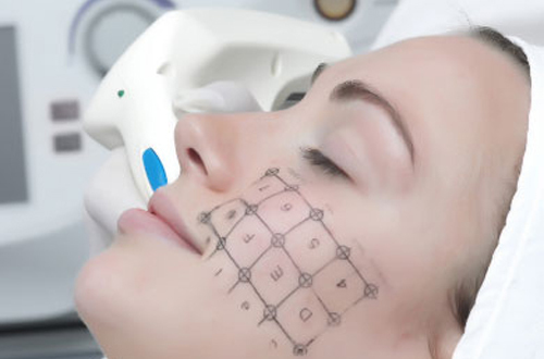 Giảm chảy xệ làn da nhờ công nghệ Thermage