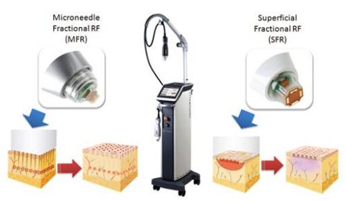 Tháng 7 sắp về, nhớ chuyện tình 38 năm trước