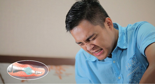 Di truyền: yếu tố hàng đầu gây bệnh gout