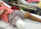 Nam thanh niên bị cưa chân vì bác sĩ chẩn đoán sai