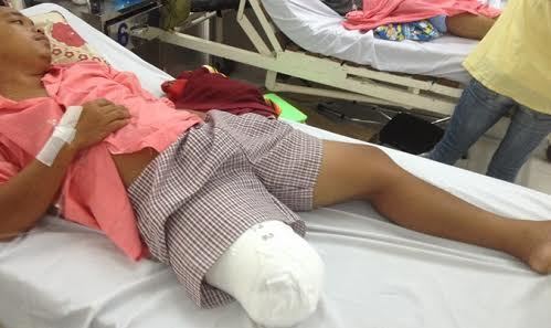 Nam thanh niên bị cưa chân vì bác sĩ chẩn đoán sai