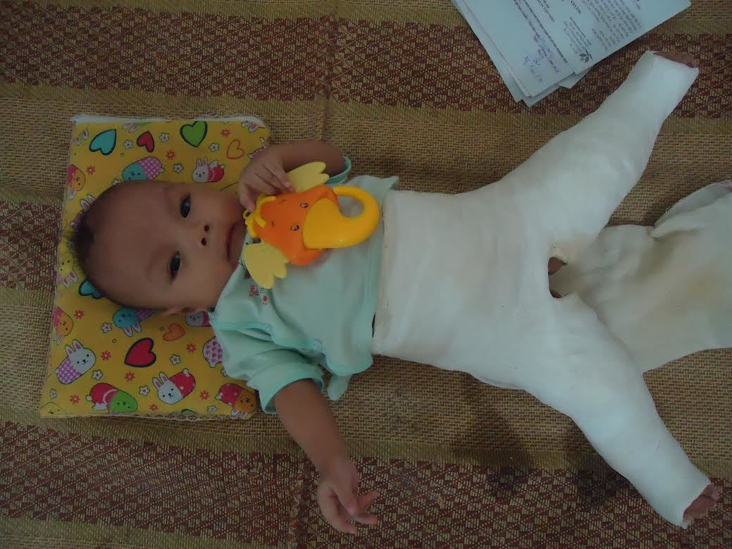 Thương bé tròn một tuổi mà phẫu thuật chân 12 lần chưa khỏi
