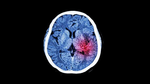 Tai biến mạch não: 10 yếu tố nguy cơ có thể dự phòng