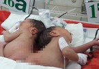 Hai bé sơ sinh dính nhau phần mông